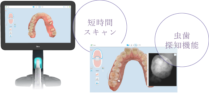 短時間スキャン・虫歯探知機能