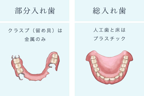 ＜部分入れ歯＞クラスプ（留め具）は金属のみ　＜総入れ歯＞人工歯と床はプラスチック