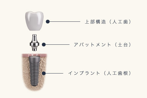 上部構造（人工歯）、アバットメント（土台）、インプラント（人工歯根）