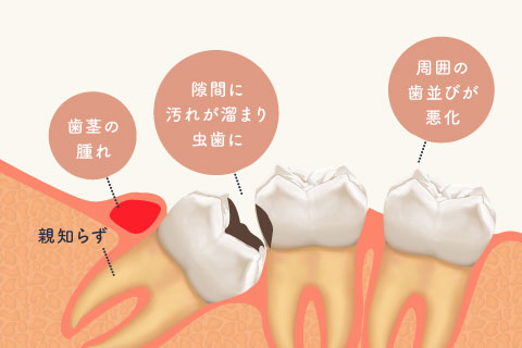 親知らずによる症状　歯茎の腫れ・隙間に汚れが溜まり虫歯に・周囲の歯並びが悪化